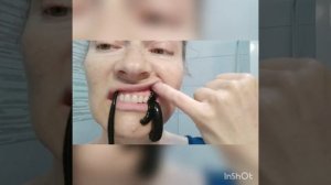 ПИЯВКИ. КОСМЕТИЧЕСКАЯ ПОСТАНОВКА НАПОЛНЕНИЕ НОСОГУБНЫХ СКЛАДОК