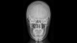 Укладка для рентгенограммы черепа