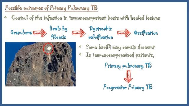 Tuberculosis - Types, Pathogenesis, Signs and Symptoms, Diagnosis, Treatment and Prevention смотреть онлайн