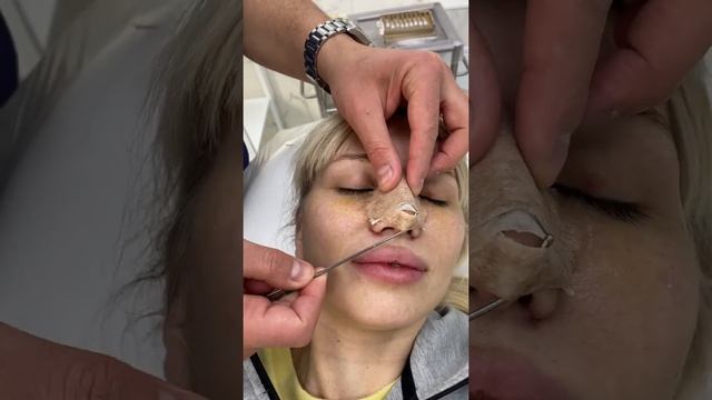 Замена гипса и удаление швов после ринопластики у доктора Акопова Арама Арутровича смотреть онлайн