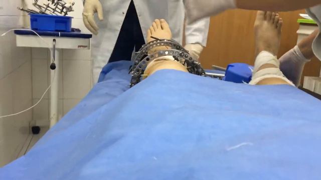 Кривые ноги Аппарат Илизарова смотреть онлайн