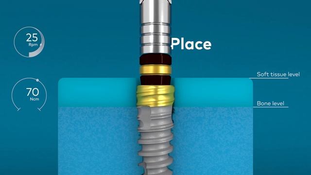 Nobel Biocare N1™ system site preparation смотреть онлайн