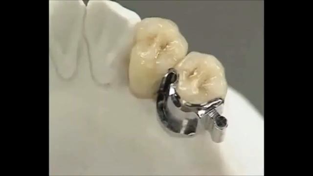 Бюгельные протезы смотреть онлайн