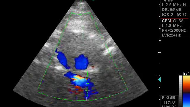 стеноз основной артерии