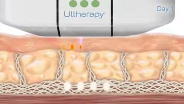 Ultherapy - How it Works? смотреть онлайн