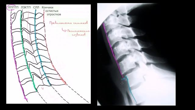 Оценка расположения шейного отдела позвоночника (шеи) на рентгеновских снимках в боковой проекции смотреть онлайн