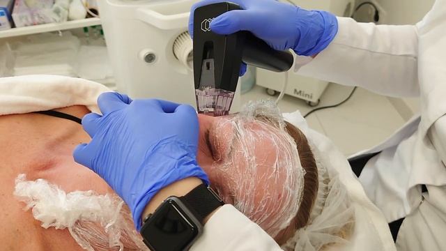 Микроигольчатый RF лифтинг лица - Morpheus 8 смотреть онлайн