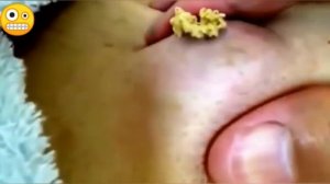 Слабонервным не смотреть! Прыщик выдавили. О май гат ...