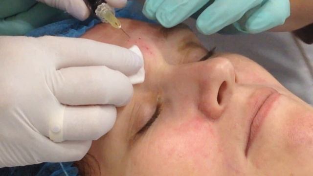 АирисКом: студенты учатся; отработка студента; заполнение межбровной складки смотреть онлайн