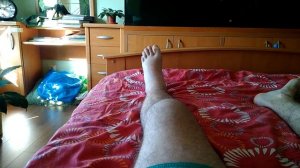 Перелом мыщелка большеберцовой кости (часть 2 из 5)