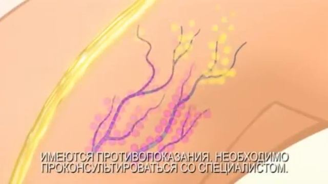 troxevasin 20 смотреть онлайн