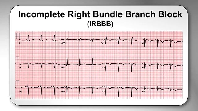 AME Minute: Why Is An Incomplete Right Bundle Branch Block Considered A Normal Variant?