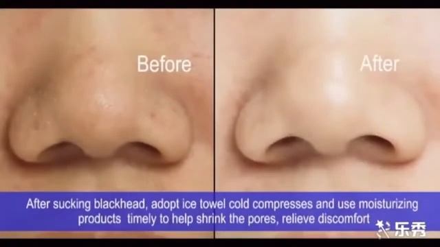 Вакуумный очиститель пор лица COMEDO SUCTION TOOL смотреть онлайн
