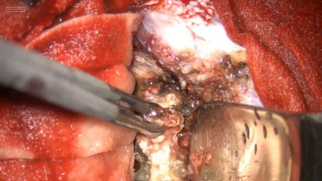 Meningioma #meningioma #AmerBadran смотреть онлайн