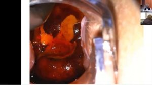 Конизация шейки матки. Мастер клас Алматы 26.11.2022.