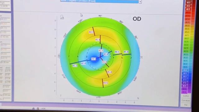 Лазерная коррекция зрения Femto Super LASIK