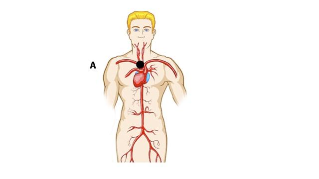 Нормы скорости пульсовой волны смотреть онлайн