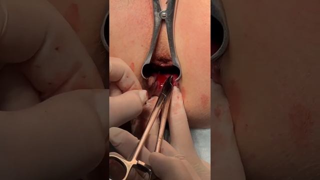 Свищ заднего прохода Filac (+ NanoFat) Fistula Laser Closure аноректальный свищ (липографтинг) смотреть онлайн