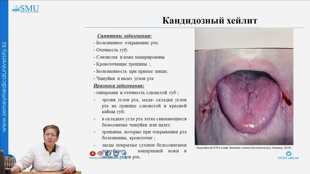 Кандидоз смотреть онлайн