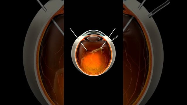 Хирургия стекловидного тела