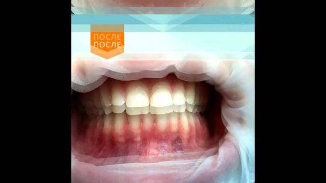 Отбеливание зубов в Краснодаре смотреть онлайн