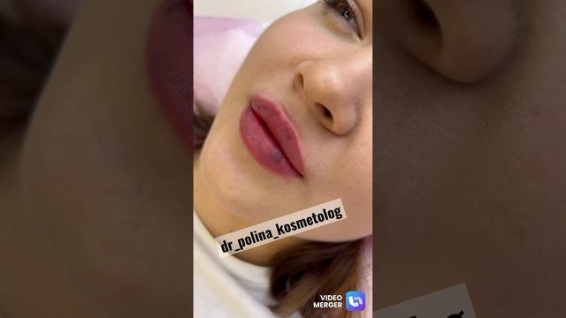 Увеличение губ Москва / Электросталь ❤️ косметология?контурная пластика смотреть онлайн