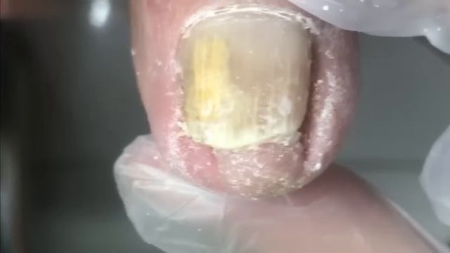 Amazing Two Toenails, Trim Ingrown Toenails~【Crazy Pedicure Room】