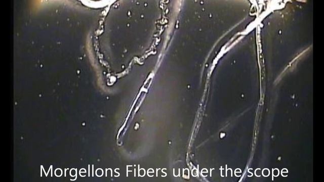 MORGELLONS EVIDENCE YOUR MD's Can't Deny! смотреть онлайн