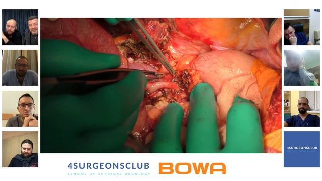 Трисекционэктомия - максимальный обьем резекции печени в хирургическом лечении опухоли Клацкина смотреть онлайн