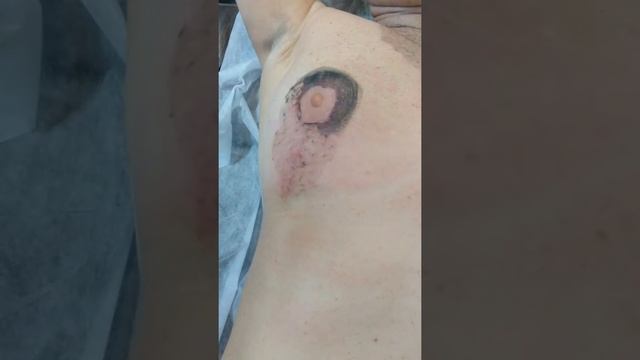 Карбоновый пилинг на швы после пластики груди... Светлана Яковенко Оренбург смотреть онлайн