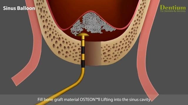 Sinus elevation with crestal approach using sinus balloon смотреть онлайн