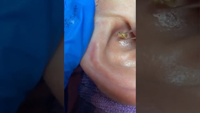 Огромный угрь в ухе смотреть онлайн