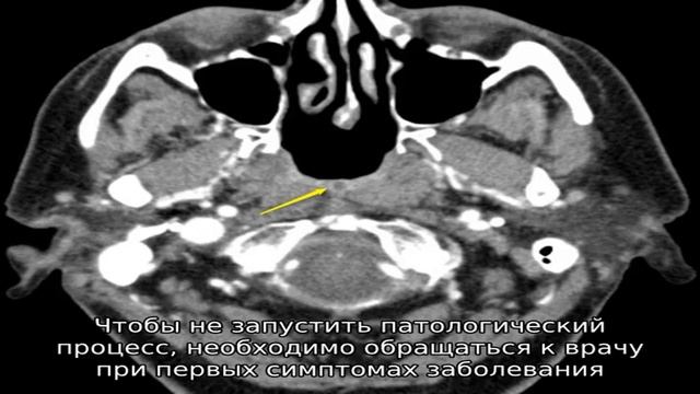 Что такое киста Торнвальда? смотреть онлайн