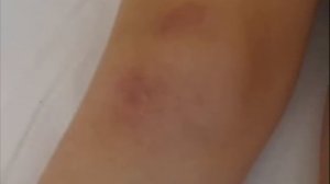 Системная красная волчанка © Systemic lupus erythematosus