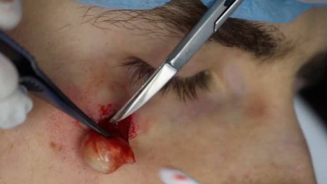 Удaлeниe aтepoмы нa лицe. Kлиникa дoктoрa Нeлип смотреть онлайн