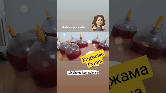 Хиджама по сунне,лечение методом капиллярного кровопускания❤ смотреть онлайн