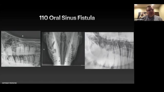 Oral Nasal and Sinus Fistula - Case Study смотреть онлайн