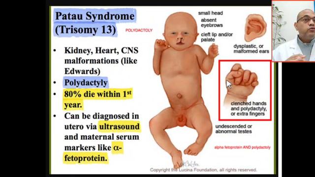 case 331 trisomy 13 patau syndrome, holoprocencephaly sequence, polydactaly, cleft lip, palate, смотреть онлайн