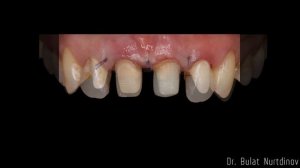 Устранение воспаления десен  под коронками