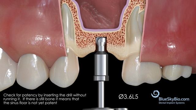 Sinus Lift Kit being used non guided смотреть онлайн
