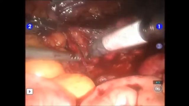 Extended Pelvic Lymph Node Dissection смотреть онлайн