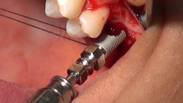 iRaise Sinus Lift Procedure, Dr Shohat I Hadera, Israel March, 2013 смотреть онлайн