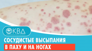 ? Сосудистые высыпания в паху и на ногах. Клинический случай №821