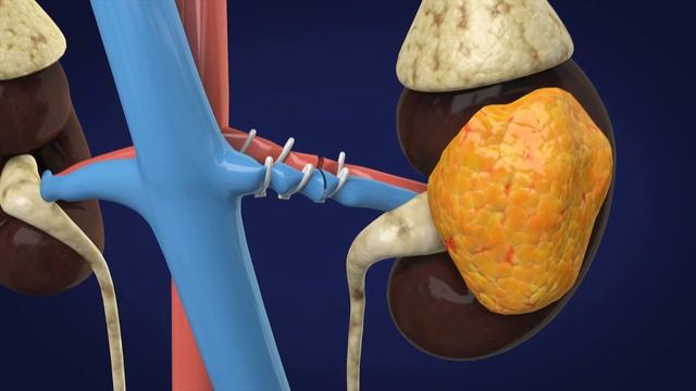 Radical Nephrectomy смотреть онлайн