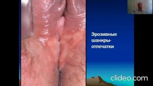 Первичный Сифилис