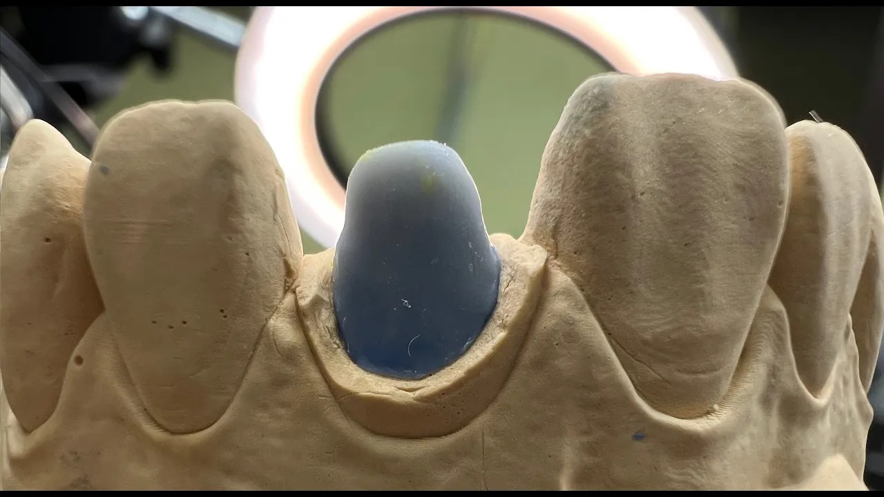 Вкладка культевая резец