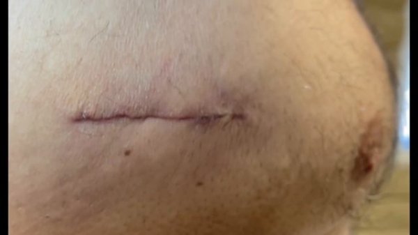 MELANOMA Follow Up! MrPopZit gets emotional. This is the follow up you have been waiting for.