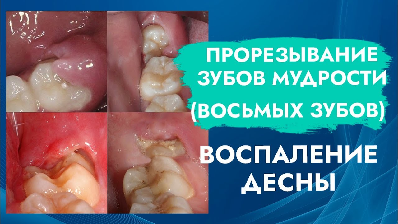 Зубы мудрости. 8 зубы. Прорезывание. Воспаление десны. смотреть онлайн