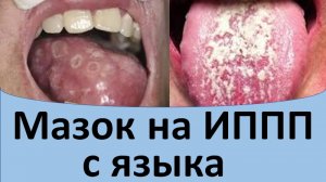 Мазок на ИППП с языка.