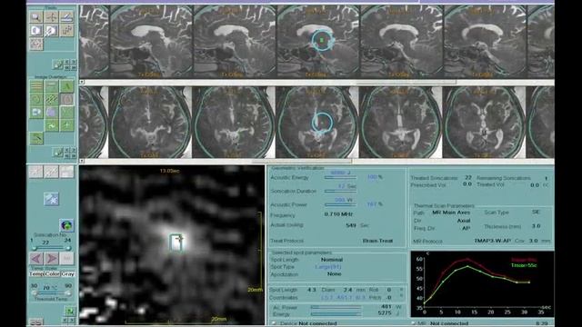 Yoav Medan: Ultrasound Surgery -- Healing Without Cuts